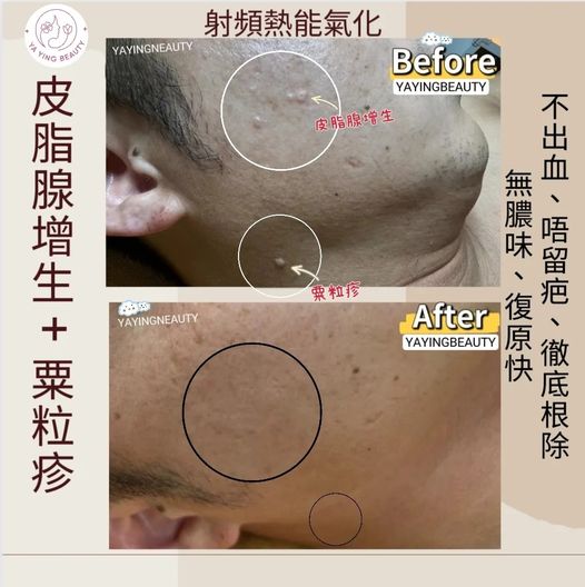 皮膚治療前後對比圖